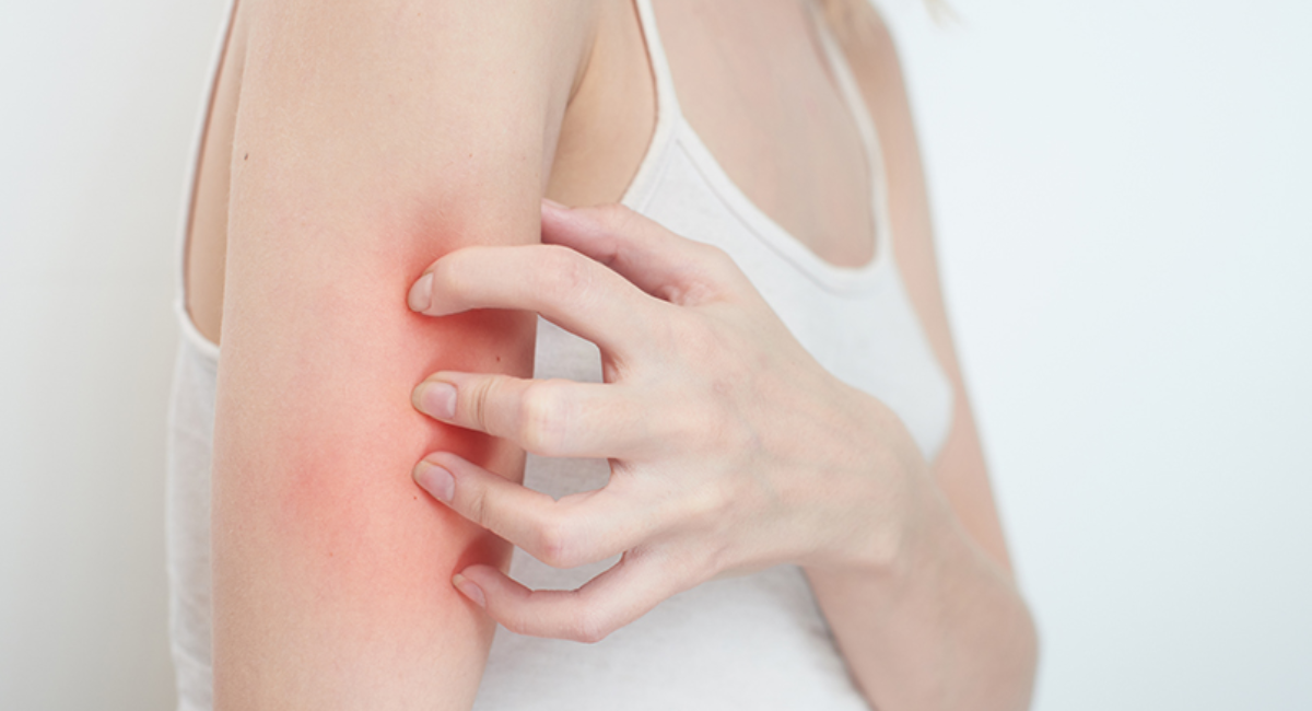 Eczema Treatment: The  Guide for Management and Cure from Eczema