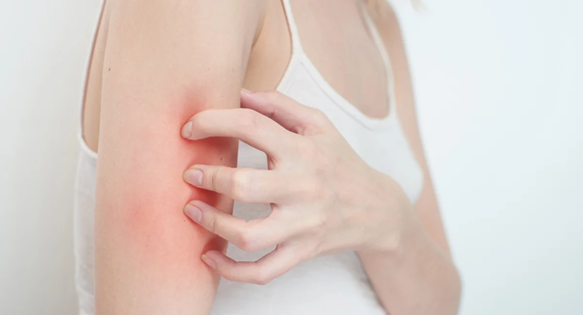Eczema Treatment: The Guide for Management and Cure from Eczema