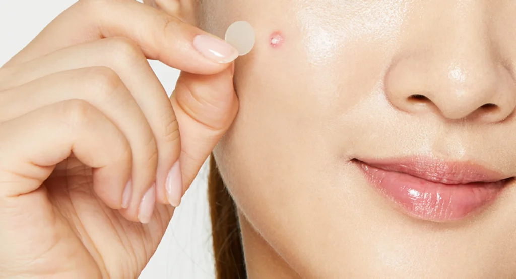 Pimple Patches: Their Operation & Best Ones to Experiment with in 2026