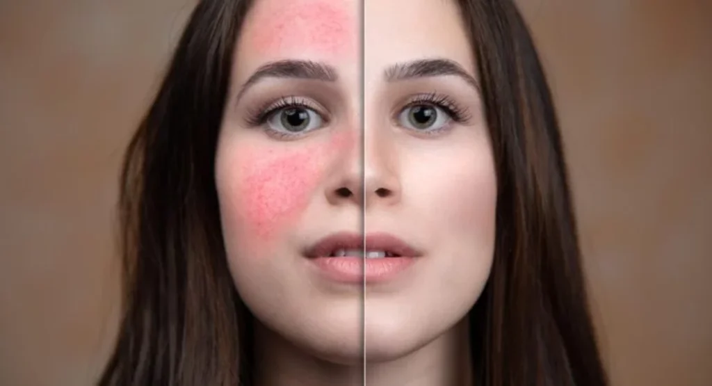 Understanding rosacea: Causes, symptoms, treatment, and tips for skin care